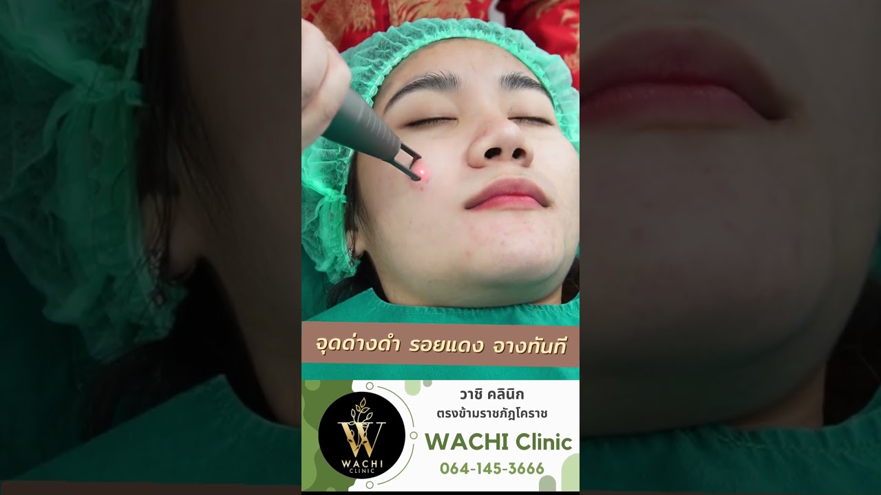เครื่องspectra gold ที่wachi clinic แก้ปัญหาฝ้า กระ จุดด่างดำ